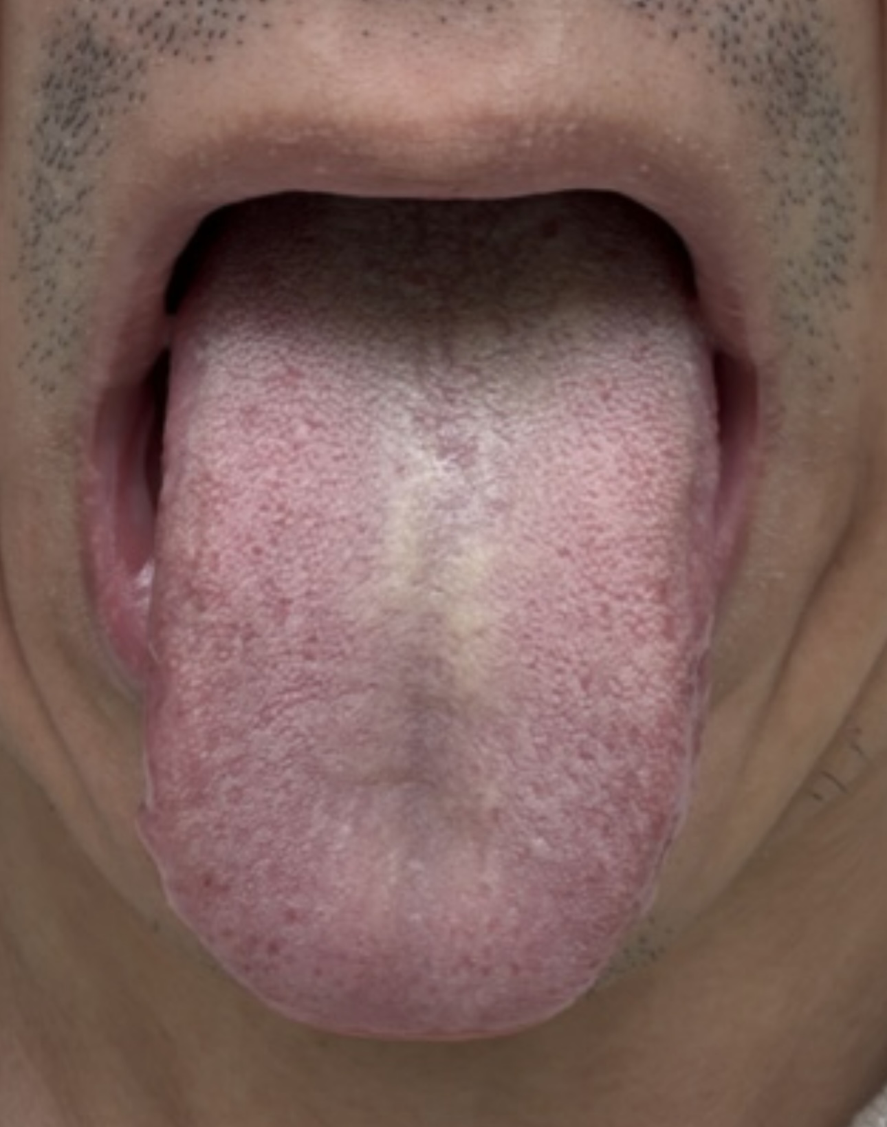 Tongue photo from a past consultation