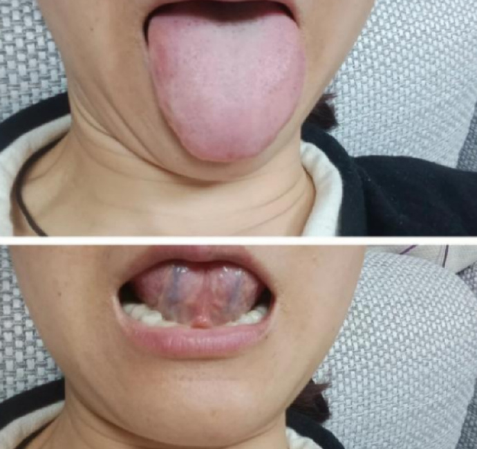 Tongue photo from a past consultation